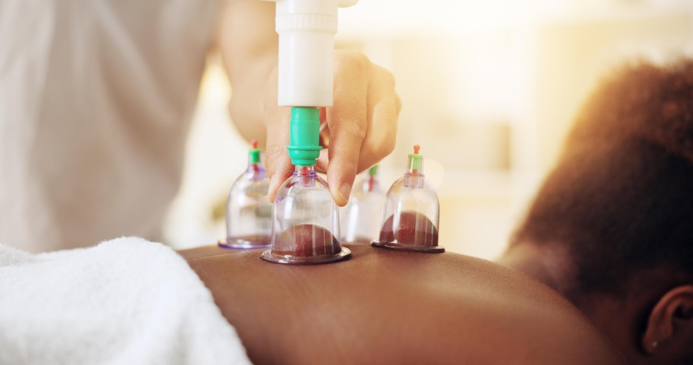 cupping therapy