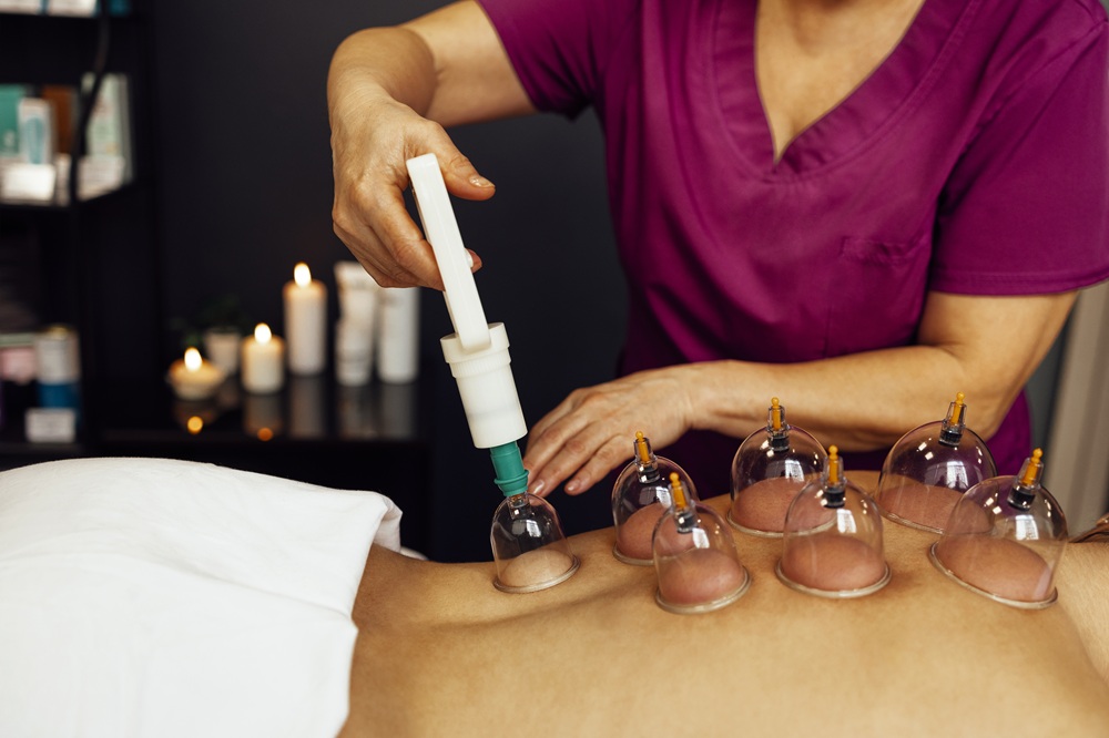 cupping therapy